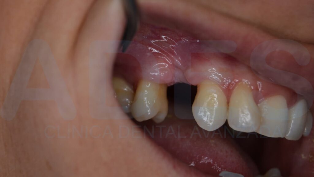 implante dental badajoz